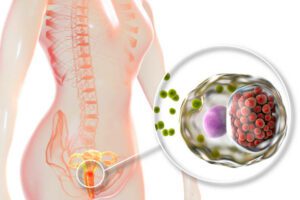 Female chlamydiosis, medical concept. 3D illustration showing close-up view of Chlamydia trachomatis bacteria infecting cells of cervix uteri