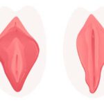 Vector vagina plastic surgery concept with stages of clitoris surgery. Female labia correction. Labiaplasty ro vaginoplasty medical operation. Gynecology and labia lips. Isolated illustration
