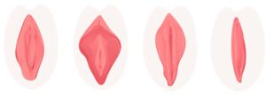 Vector vagina plastic surgery concept with stages of clitoris surgery. Female labia correction. Labiaplasty ro vaginoplasty medical operation. Gynecology and labia lips. Isolated illustration